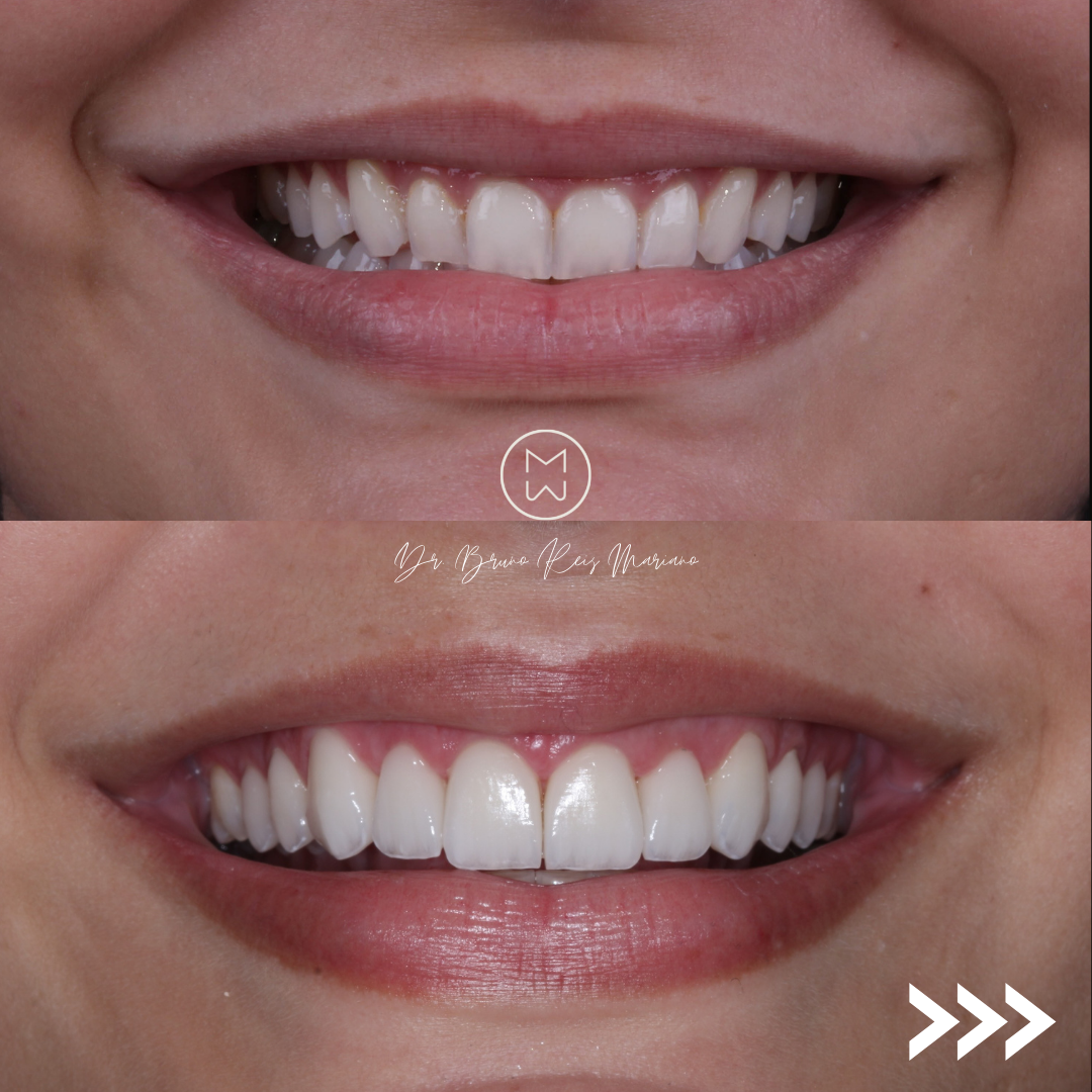 Caso clínico de transformação do sorriso 1: antes e depois