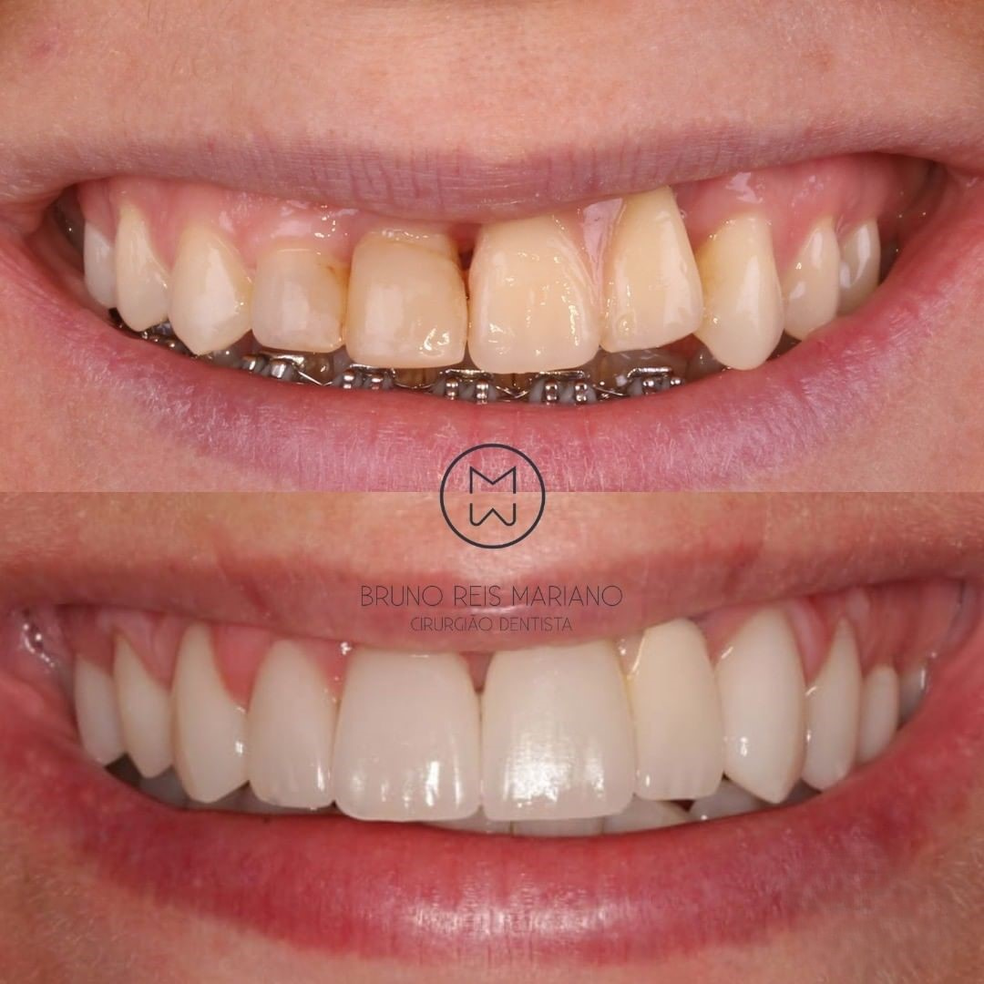 Caso clínico de transformação do sorriso 2: antes e depois