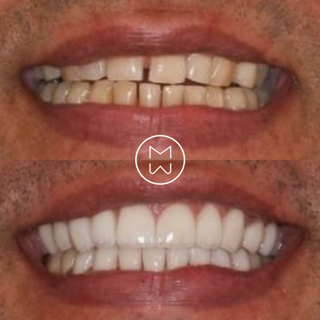 Caso clínico de transformação do sorriso 3: antes e depois